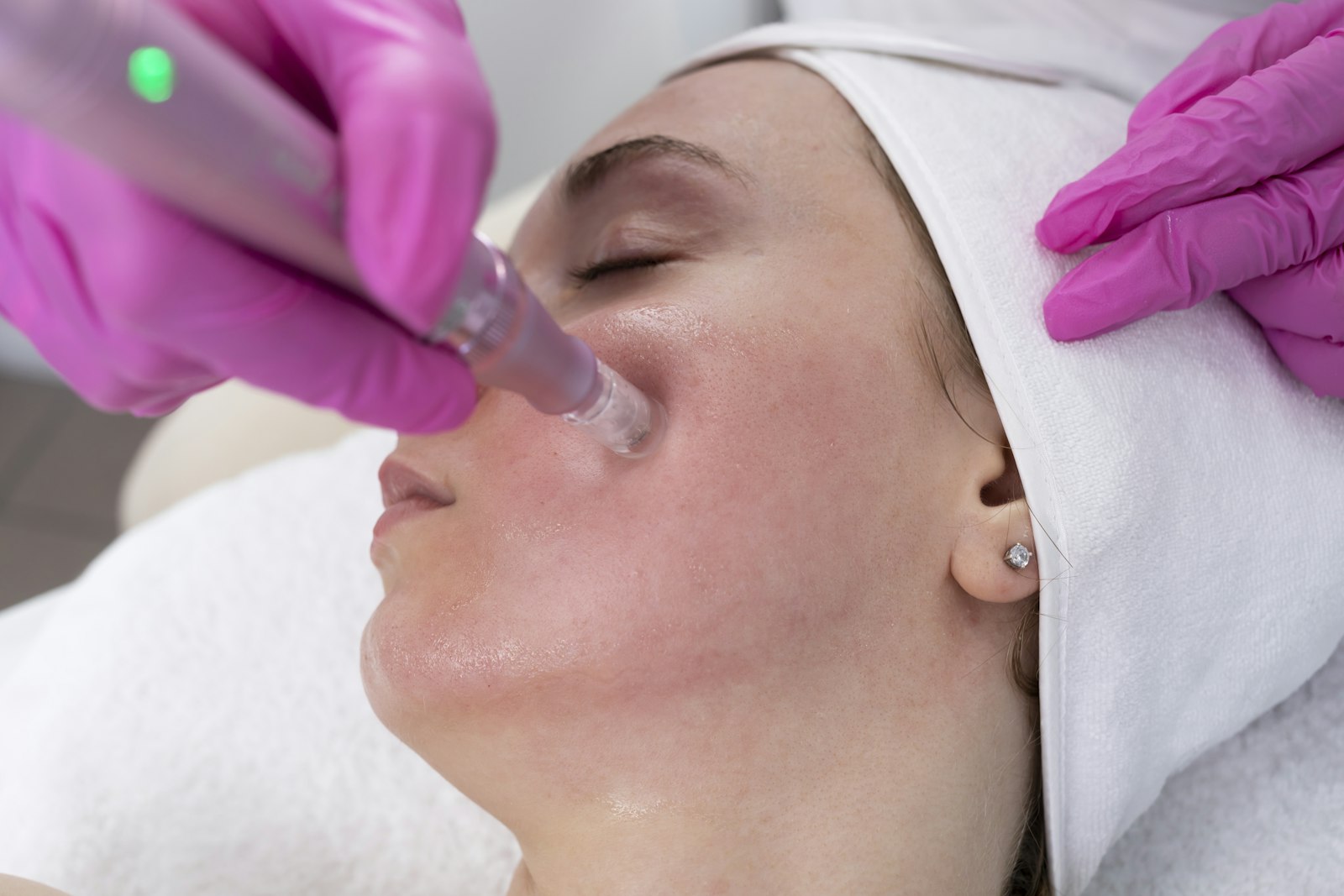 Θεραπεία microneedling στο πρόσωπο